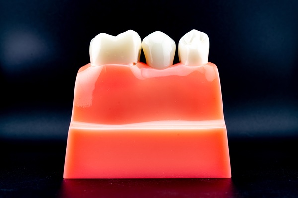 Dental Crown Placement: Front Vs  Back Teeth