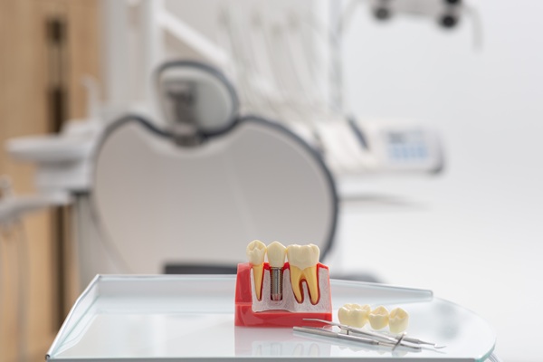 Tooth Replacement    : The Long Term Health Benefits Of Dental Implants