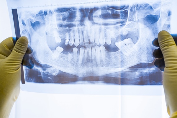 What Are Full Mouth Dental X Rays?